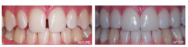 dental porcelain veneers