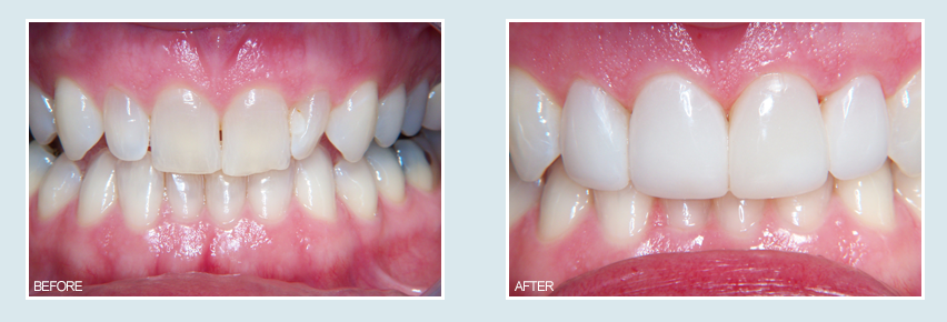 porcelain veneers