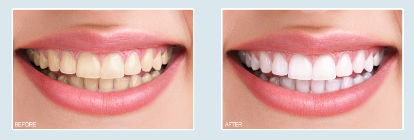 rancho santa margarita teeth whitening