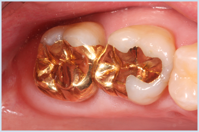 gold dental restorations